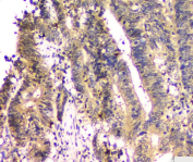 IHC staining of FFPE human colon cancer tissue with PTPN11 antibody, HRP-secondary and DAB substrate. HIER: boil tissue sections in pH8 EDTA for 20 min and allow to cool before testing.