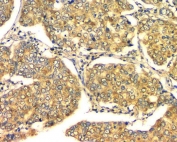 IHC staining of FFPE human breast cancer with GM130 antibody. HIER: boil tissue sections in pH8 EDTA for 20 min and allow to cool before testing.