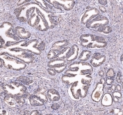IHC staining of FFPE human prostate cancer tissue with CD47 antibody at 1ug/ml. HIER: boil tissue sections in pH8 EDTA buffer for 10-20 min and allow to cool before testing.