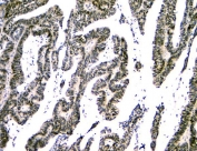 IHC staining of FFPE human intestinal cancer with NFIA antibody. HIER: boil tissue sections in pH8 EDTA for 20 min and allow to cool before testing.