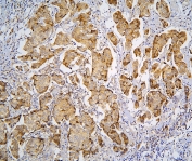 IHC staining of FFPE human breast cancer with PPA1 antibody at 1ug/ml. HIER: boil tissue sections in pH6, 10mM citrate buffer, for 10-20 min and allow to cool before testing.