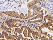 IHC staining of FFPE human intestinal cancer with PPA1 antibody at 1ug/ml. HIER: boil tissue sections in pH6, 10mM citrate buffer, for 10-20 min and allow to cool before testing.