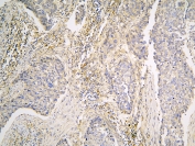 IHC staining of FFPE human lung cancer with PPA1 antibody at 1ug/ml. HIER: boil tissue sections in pH6, 10mM citrate buffer, for 10-20 min and allow to cool before testing.