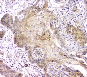 IHC staining of FFPE human esophageal squamous cancer with RAB11B antibody at 1ug/ml. HIER: boil tissue sections in pH6, 10mM citrate buffer, for 10-20 min and allow to cool before testing.