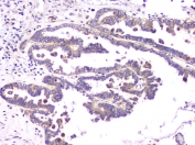 IHC staining of FFPE human ovarian cancer with RAB11B antibody at 1ug/ml. HIER: boil tissue sections in pH6, 10mM citrate buffer, for 10-20 min and allow to cool before testing.