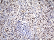 IHC staining of FFPE human lung cancer with TAF12 antibody at 1ug/ml. HIER: boil tissue sections in pH6, 10mM citrate buffer, for 10-20 min and allow to cool before testing.