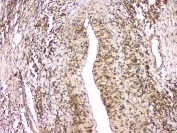 IHC staining of FFPE human lung tissue with HECTD3 antibody at 1ug/ml. HIER: boil tissue sections in pH6, 10mM citrate buffer, for 10-20 min and allow to cool before testing.