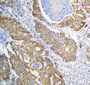 IHC staining of FFPE human intestinal cancer with DARS2 antibody at 1ug/ml. HIER: boil tissue sections in pH6, 10mM citrate buffer, for 10-20 min and allow to cool before testing.