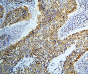 IHC staining of FFPE human lung cancer with DARS2 antibody at 1ug/ml. HIER: boil tissue sections in pH6, 10mM citrate buffer, for 10-20 min and allow to cool before testing.
