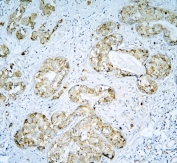 IHC staining of FFPE human breast cancer with DARS2 antibody at 1ug/ml. HIER: boil tissue sections in pH6, 10mM citrate buffer, for 10-20 min and allow to cool before testing.