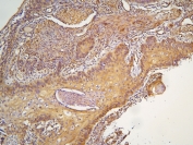 IHC staining of FFPE human esophageal squamous cancer with HOOK3 antibody at 1ug/ml. HIER: boil tissue sections in pH6, 10mM citrate buffer, for 10-20 min and allow to cool before testing.