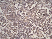 IHC staining of FFPE human glioma with HOOK3 antibody at 1ug/ml. HIER: boil tissue sections in pH6, 10mM citrate buffer, for 10-20 min and allow to cool before testing.