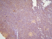IHC staining of FFPE human sarcoma with HOOK3 antibody at 1ug/ml. HIER: boil tissue sections in pH6, 10mM citrate buffer, for 10-20 min and allow to cool before testing.