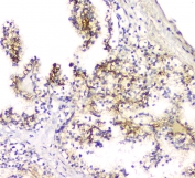 IHC staining of FFPE human renal cancer with SCN4B antibody at 1ug/ml. HIER: boil tissue sections in pH6, 10mM citrate buffer, for 10-20 min and allow to cool before testing.