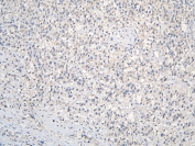 IHC staining of FFPE human testis cancer with CCDC36 antibody at 1ug/ml. HIER: boil tissue sections in pH6, 10mM citrate buffer, for 10-20 min and allow to cool before testing.
