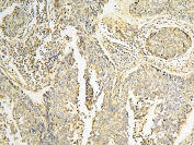 IHC staining of FFPE human lung cancer with CPAMD8 antibody at 1ug/ml. HIER: boil tissue sections in pH6, 10mM citrate buffer, for 10-20 min and allow to cool before testing.