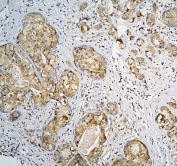 IHC staining of FFPE human breast cancer with CPAMD8 antibody at 1ug/ml. HIER: boil tissue sections in pH6, 10mM citrate buffer, for 10-20 min and allow to cool before testing.
