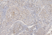 IHC staining of FFPE human lung cancer with SFRP1 antibody at 1ug/ml. HIER: boil tissue sections in pH6, 10mM citrate buffer, for 10-20 min and allow to cool before testing.