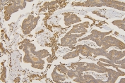IHC staining of FFPE human colon cancer with SFRP1 antibody at 1ug/ml. HIER: boil tissue sections in pH6, 10mM citrate buffer, for 10-20 min and allow to cool before testing.