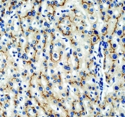 IHC staining of FFPE human liver cancer with MRP2 antibody. HIER: boil tissue sections in pH8 EDTA buffer for 10-20 min and allow to cool before testing.