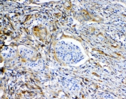 IHC staining of FFPE human rectal cancer with MRP2 antibody at 1ug/ml. HIER: boil tissue sections in pH6, 10mM citrate buffer, for 10-20 min and allow to cool before testing.