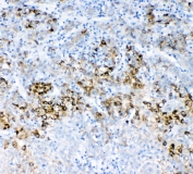 IHC staining of FFPE human liver cancer with MRP2 antibody at 1ug/ml. HIER: boil tissue sections in pH6, 10mM citrate buffer, for 10-20 min and allow to cool before testing.