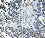 IHC staining of FFPE human lung cancer with MRP2 antibody at 1ug/ml. HIER: boil tissue sections in pH6, 10mM citrate buffer, for 10-20 min and allow to cool before testing.