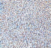 IHC staining of FFPE human liver cancer with MRP2 antibody. HIER: boil tissue sections in pH8 EDTA buffer for 10-20 min and allow to cool before testing.