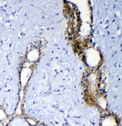 IHC staining of FFPE human breast cancer with MRP2 antibody at 1ug/ml. HIER: boil tissue sections in pH6, 10mM citrate buffer, for 10-20 min and allow to cool before testing.