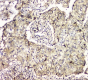 IHC staining of FFPE human lung cancer tissue with MCUR1 antibody at 1ug/ml. HIER: boil tissue sections in pH6, 10mM citrate buffer, for 10-20 min and allow to cool before testing.