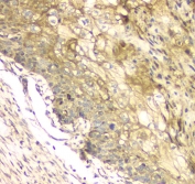 IHC staining of FFPE human esophageal squamous cancer with MCUR1 antibody at 1ug/ml. HIER: boil tissue sections in pH6, 10mM citrate buffer, for 10-20 min and allow to cool before testing.