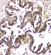 IHC staining of FFPE human ovarian cancer tissue with MCUR1 antibody at 1ug/ml. HIER: boil tissue sections in pH6, 10mM citrate buffer, for 10-20 min and allow to cool before testing.