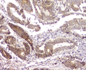 IHC staining of FFPE human intestinal cancer with RMI2 antibody at 1ug/ml. HIER: boil tissue sections in pH6, 10mM citrate buffer, for 10-20 min and allow to cool before testing.