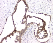 IHC staining of FFPE human breast cancer with RMI2 antibody at 1ug/ml. HIER: boil tissue sections in pH6, 10mM citrate buffer, for 10-20 min and allow to cool before testing.