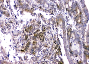 IHC staining of FFPE human intestinal cancer with RMI2 antibody at 1ug/ml. HIER: boil tissue sections in pH6, 10mM citrate buffer, for 10-20 min and allow to cool before testing.