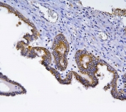 IHC staining of FFPE human ovarian cancer tissue with HOOK2 antibody. HIER: boil tissue sections in pH8 EDTA buffer, for 10-20 min and allow to cool before testing.