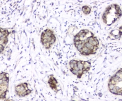 IHC staining of FFPE human breast cancer with TIMM17A antibody at 1ug/ml. HIER: boil tissue sections in pH6, 10mM citrate buffer, for 10-20 min and allow to cool before testing.