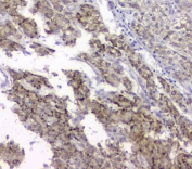 IHC staining of FFPE human liver cancer with TIMM17A antibody at 1ug/ml. HIER: boil tissue sections in pH6, 10mM citrate buffer, for 10-20 min and allow to cool before testing.