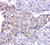 IHC staining of FFPE human lung cancer with TIMM17A antibody at 1ug/ml. HIER: boil tissue sections in pH6, 10mM citrate buffer, for 10-20 min and allow to cool before testing.