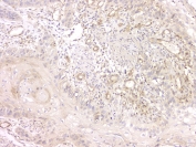 IHC staining of FFPE human esophageal squamous cancer with SRCIN1 antibody at 1ug/ml. HIER: boil tissue sections in pH6, 10mM citrate buffer, for 10-20 min and allow to cool before testing.