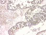 IHC staining of FFPE human ovarian cancer with SRCIN1 antibody at 1ug/ml. HIER: boil tissue sections in pH6, 10mM citrate buffer, for 10-20 min and allow to cool before testing.