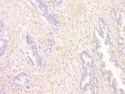 IHC staining of FFPE human ovarian cancer with SRCIN1 antibody at 1ug/ml. HIER: boil tissue sections in pH6, 10mM citrate buffer, for 10-20 min and allow to cool before testing.