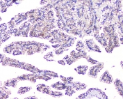 IHC staining of FFPE human renal cancer with TMEM166 antibody at 1ug/ml. HIER: boil tissue sections in pH6, 10mM citrate buffer, for 10-20 min and allow to cool before testing.
