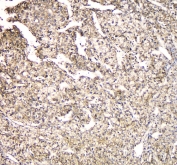 IHC staining of FFPE human liver cancer with TMEM166 antibody at 1ug/ml. HIER: boil tissue sections in pH6, 10mM citrate buffer, for 10-20 min and allow to cool before testing.