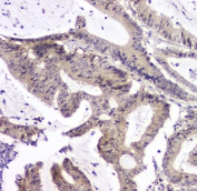 IHC staining of FFPE human intestinal cancer with PPCS antibody at 1ug/ml. HIER: boil tissue sections in pH6, 10mM citrate buffer, for 10-20 min and allow to cool before testing.