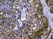IHC staining of FFPE human stomach cancer with SIRT4 antibody at 1ug/ml. HIER: boil tissue sections in pH6, 10mM citrate buffer, for 10-20 min and allow to cool before testing.