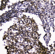 IHC staining of FFPE human glioma with SIRT4 antibody at 1ug/ml. HIER: boil tissue sections in pH6, 10mM citrate buffer, for 10-20 min and allow to cool before testing.