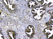 IHC staining of FFPE human ovarian cancer with SIRT4 antibody at 1ug/ml. HIER: boil tissue sections in pH6, 10mM citrate buffer, for 10-20 min and allow to cool before testing.