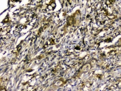 IHC staining of FFPE human rectal cancer with SIRT4 antibody at 1ug/ml. HIER: boil tissue sections in pH6, 10mM citrate buffer, for 10-20 min and allow to cool before testing.