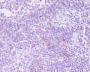 IHC staining of FFPE human tonsil tissue with CD25 antibody. HIER: boil tissue sections in pH6, 10mM citrate buffer, for 10-20 min and allow to cool before testing.